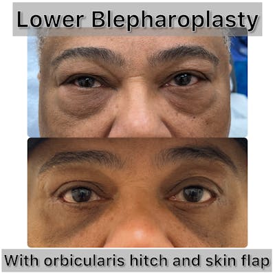 Lower Blepharoplasty Before & After Gallery - Patient 297271 - Image 1