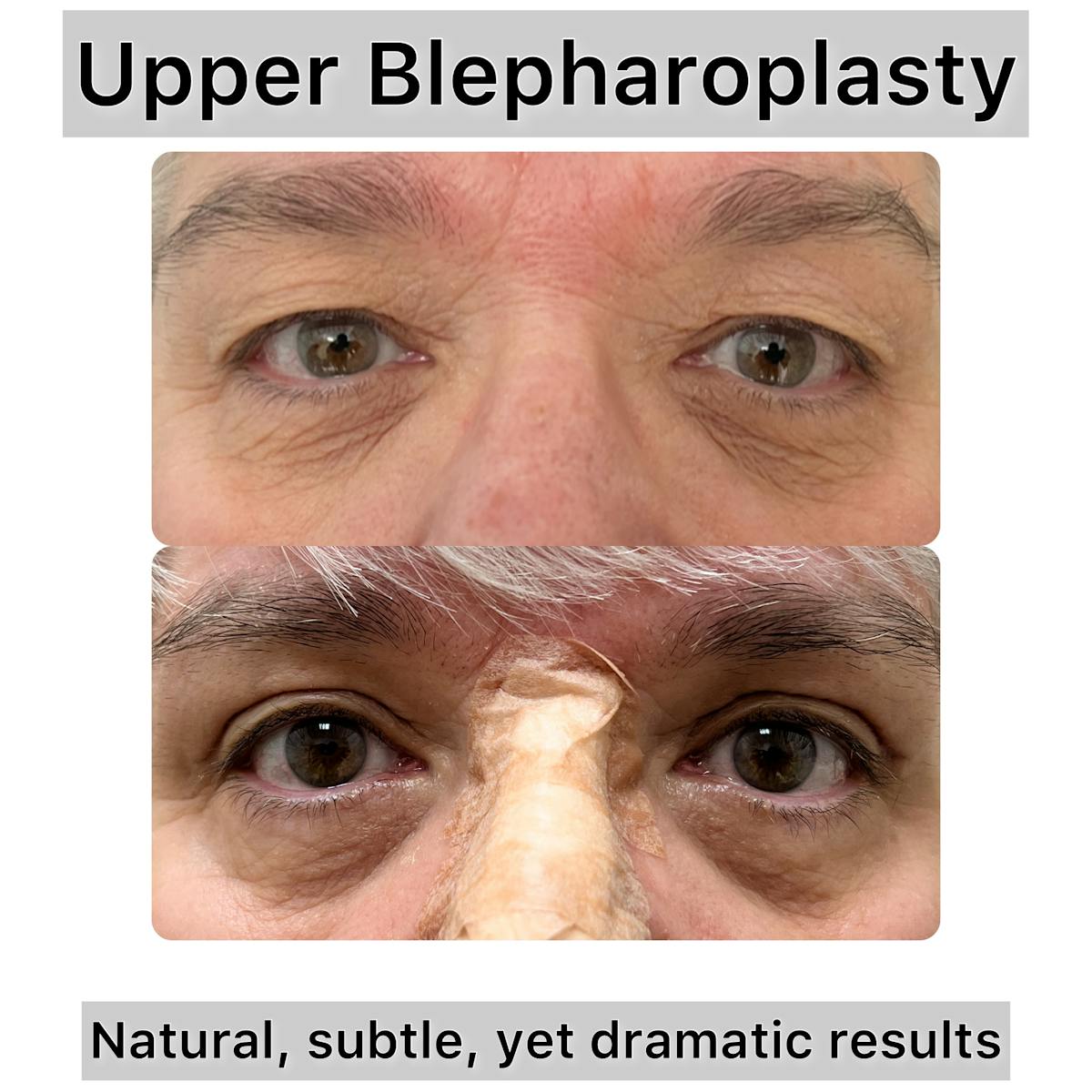 Upper Blepharoplasty Before & After Gallery - Patient 654174 - Image 1