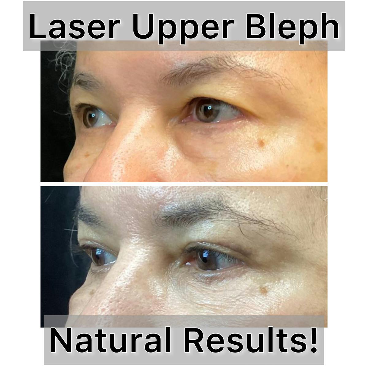 Upper Blepharoplasty Before & After Gallery - Patient 365083 - Image 1