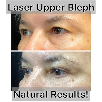 Upper Blepharoplasty Before & After Gallery - Patient 365083 - Image 1