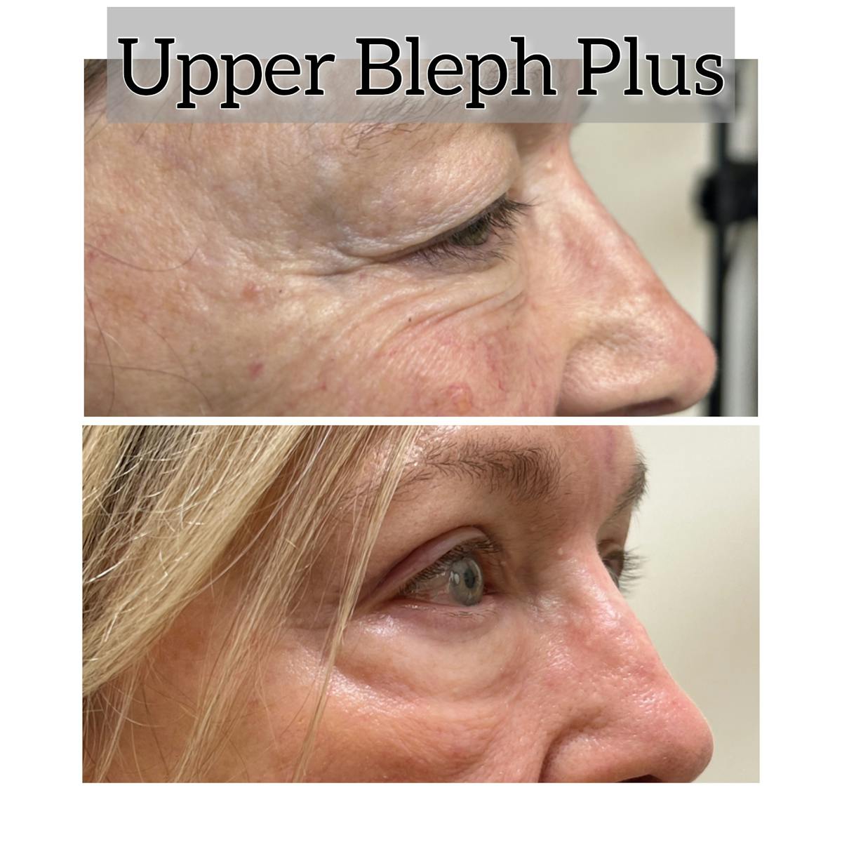 Upper Blepharoplasty Before & After Gallery - Patient 815263 - Image 1