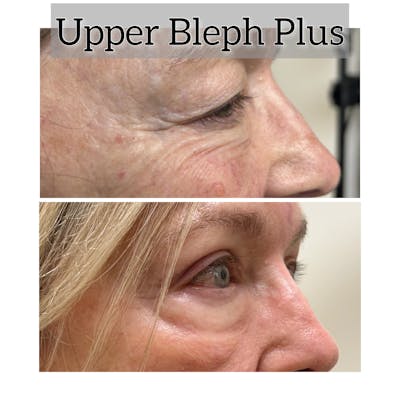 Upper Blepharoplasty Before & After Gallery - Patient 815263 - Image 1