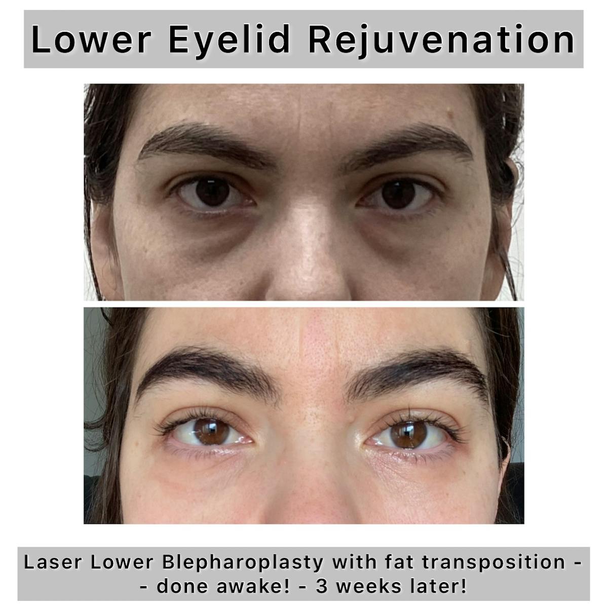Lower Blepharoplasty Before & After Gallery - Patient 122054 - Image 1
