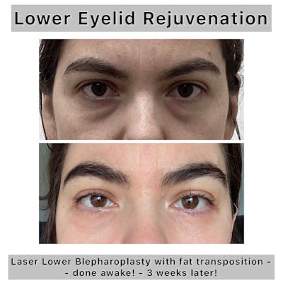 Lower Blepharoplasty Before & After Gallery - Patient 122054 - Image 1