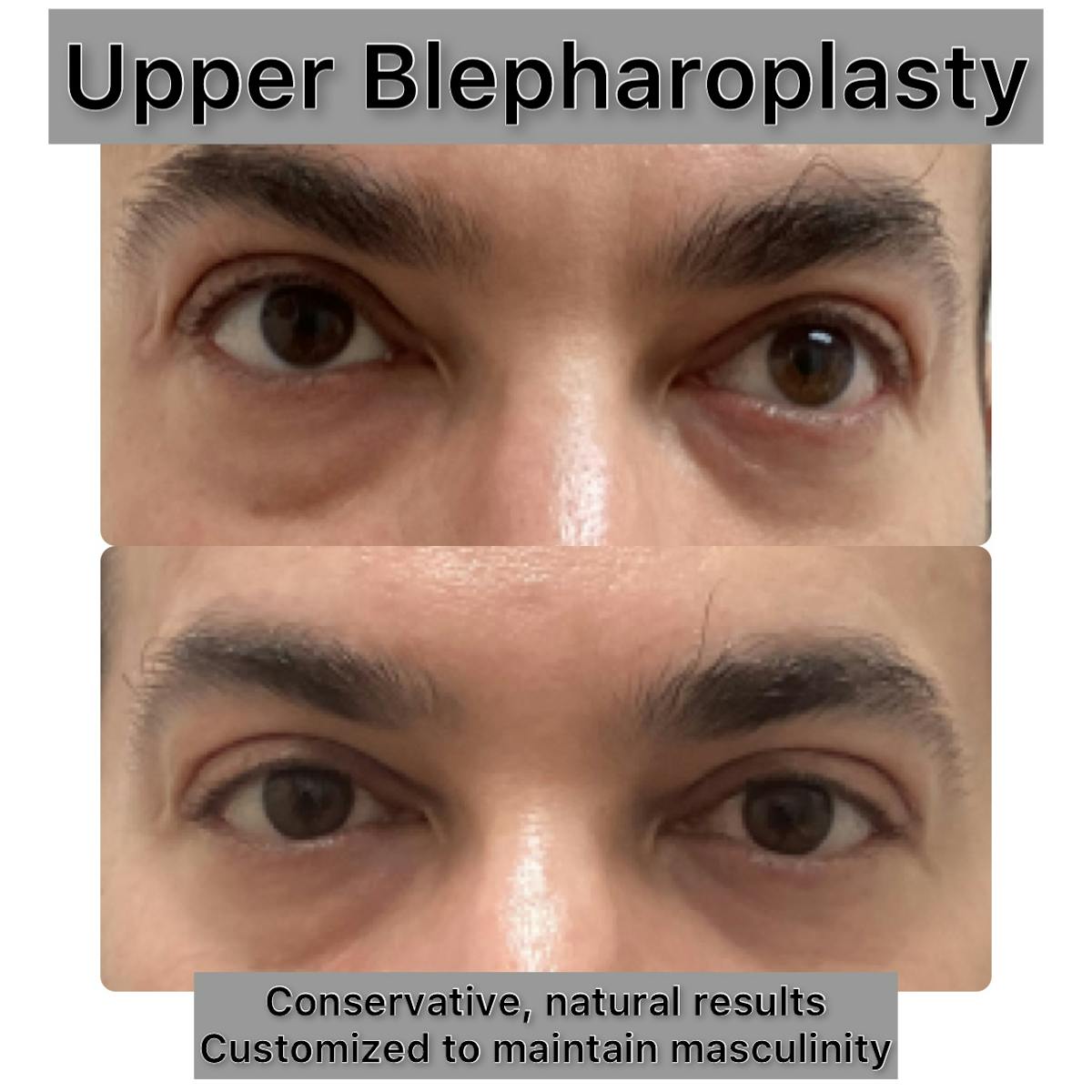 Upper Blepharoplasty Before & After Gallery - Patient 181696 - Image 1