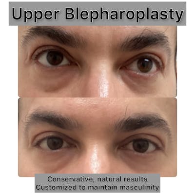 Upper Blepharoplasty Before & After Gallery - Patient 181696 - Image 1