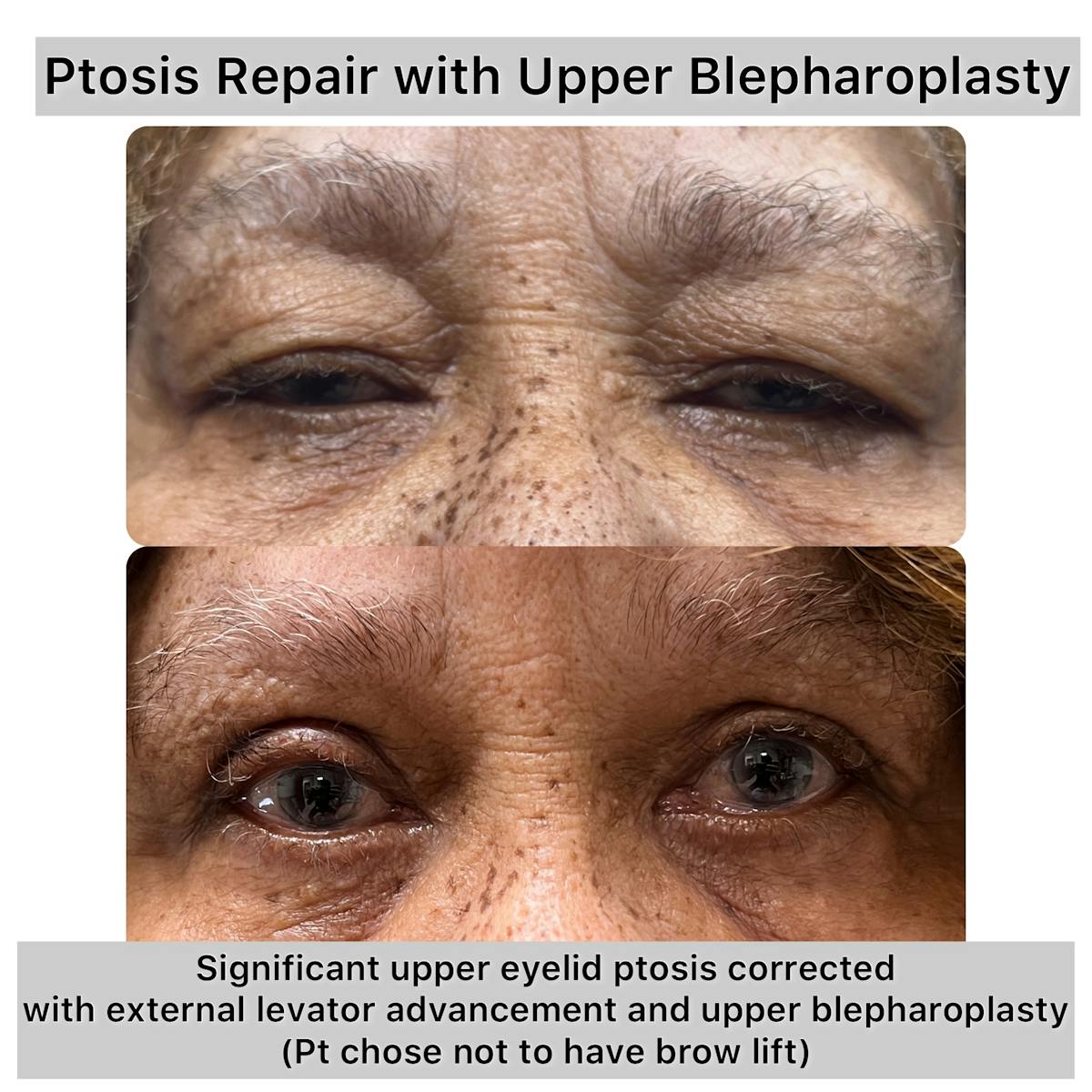 Ptosis Repair Before & After Gallery - Patient 263158 - Image 1