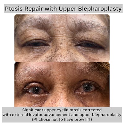 Upper Blepharoplasty Before & After Gallery - Patient 414287 - Image 1