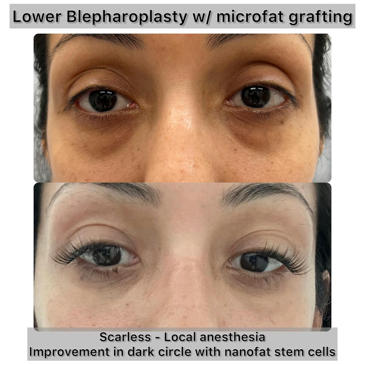 Fat Grafting Before & After Gallery - Patient 210122 - Image 1