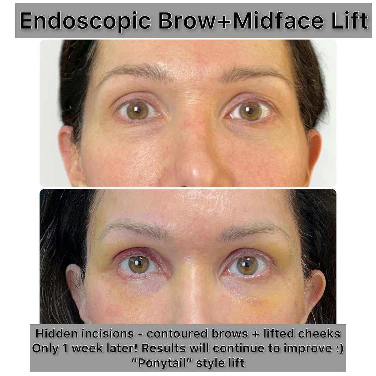 Brow Lift Before & After Gallery - Patient 267575 - Image 1