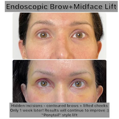 Brow Lift Before & After Gallery - Patient 267575 - Image 1