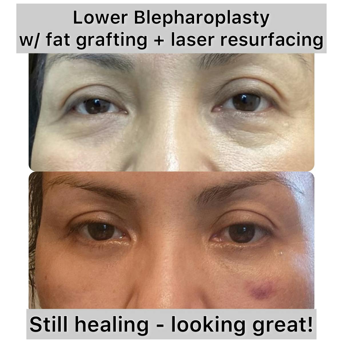 Fat Grafting Before & After Gallery - Patient 273505 - Image 1