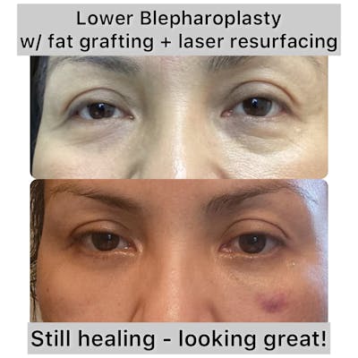 Fat Grafting Before & After Gallery - Patient 273505 - Image 1