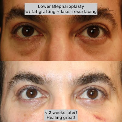 Fat Grafting Before & After Gallery - Patient 400255 - Image 1