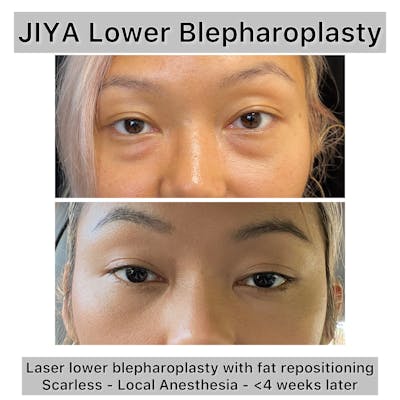 Lower Blepharoplasty Before & After Gallery - Patient 162886 - Image 1