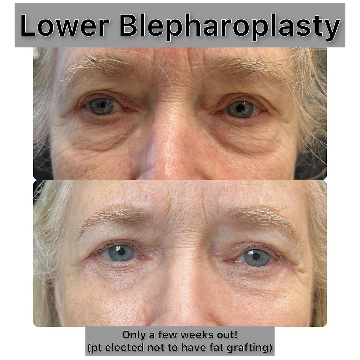Lower Blepharoplasty Before & After Gallery - Patient 294181 - Image 1