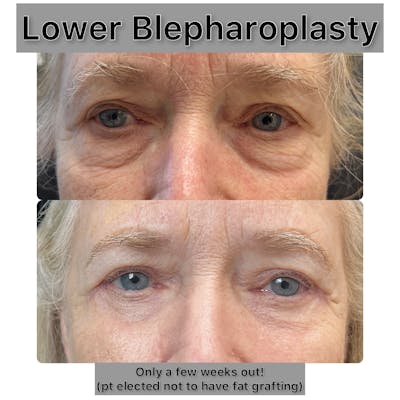 Lower Blepharoplasty Before & After Gallery - Patient 294181 - Image 1