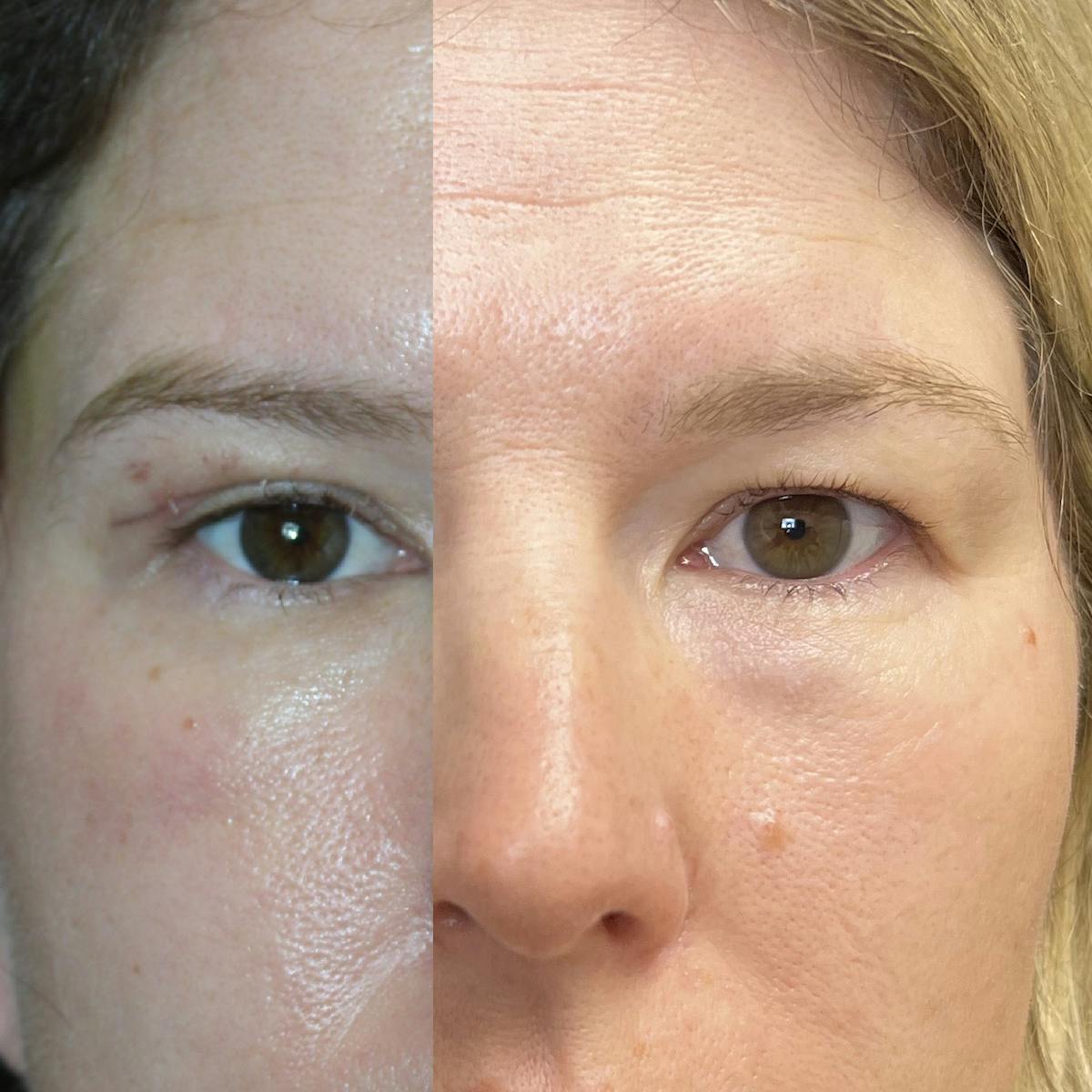 Upper Blepharoplasty Before & After Gallery - Patient 560427 - Image 1