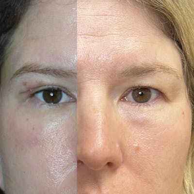 Upper Blepharoplasty Before & After Gallery - Patient 560427 - Image 1