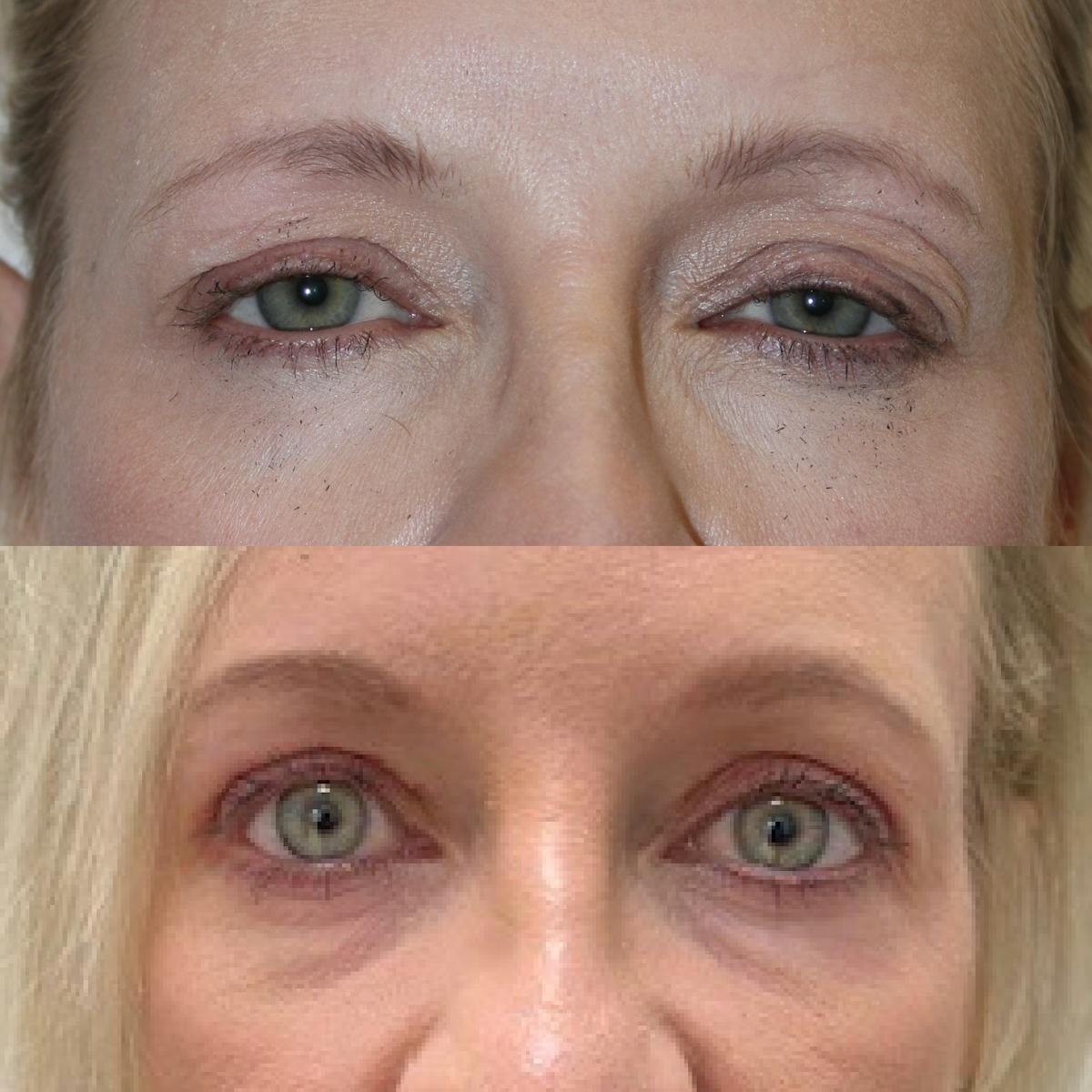 Upper and Lower Blepharoplasty Before & After Gallery - Patient 216623 - Image 1
