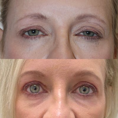 Upper and Lower Blepharoplasty Before & After Gallery - Patient 216623 - Image 1