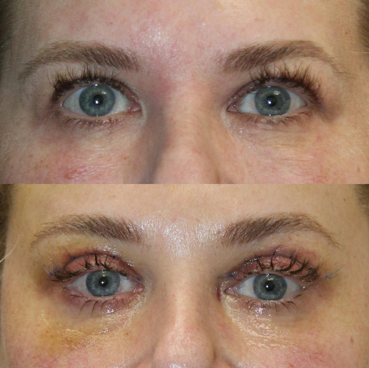Upper Blepharoplasty Before & After Gallery - Patient 420692 - Image 1