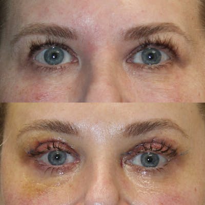 Upper Blepharoplasty Before & After Gallery - Patient 420692 - Image 1