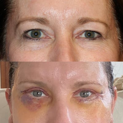 Upper and Lower Blepharoplasty Before & After Gallery - Patient 400238 - Image 1