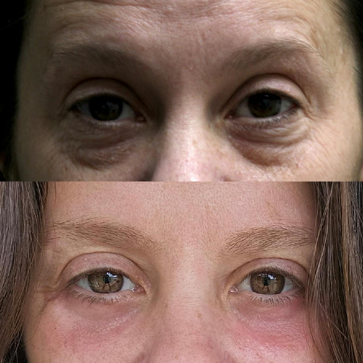 Lower Blepharoplasty Before & After Gallery - Patient 158201 - Image 1