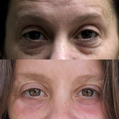 Lower Blepharoplasty Before & After Gallery - Patient 158201 - Image 1
