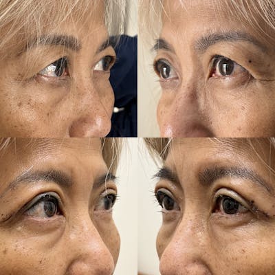 Upper Blepharoplasty Before & After Gallery - Patient 219491 - Image 1