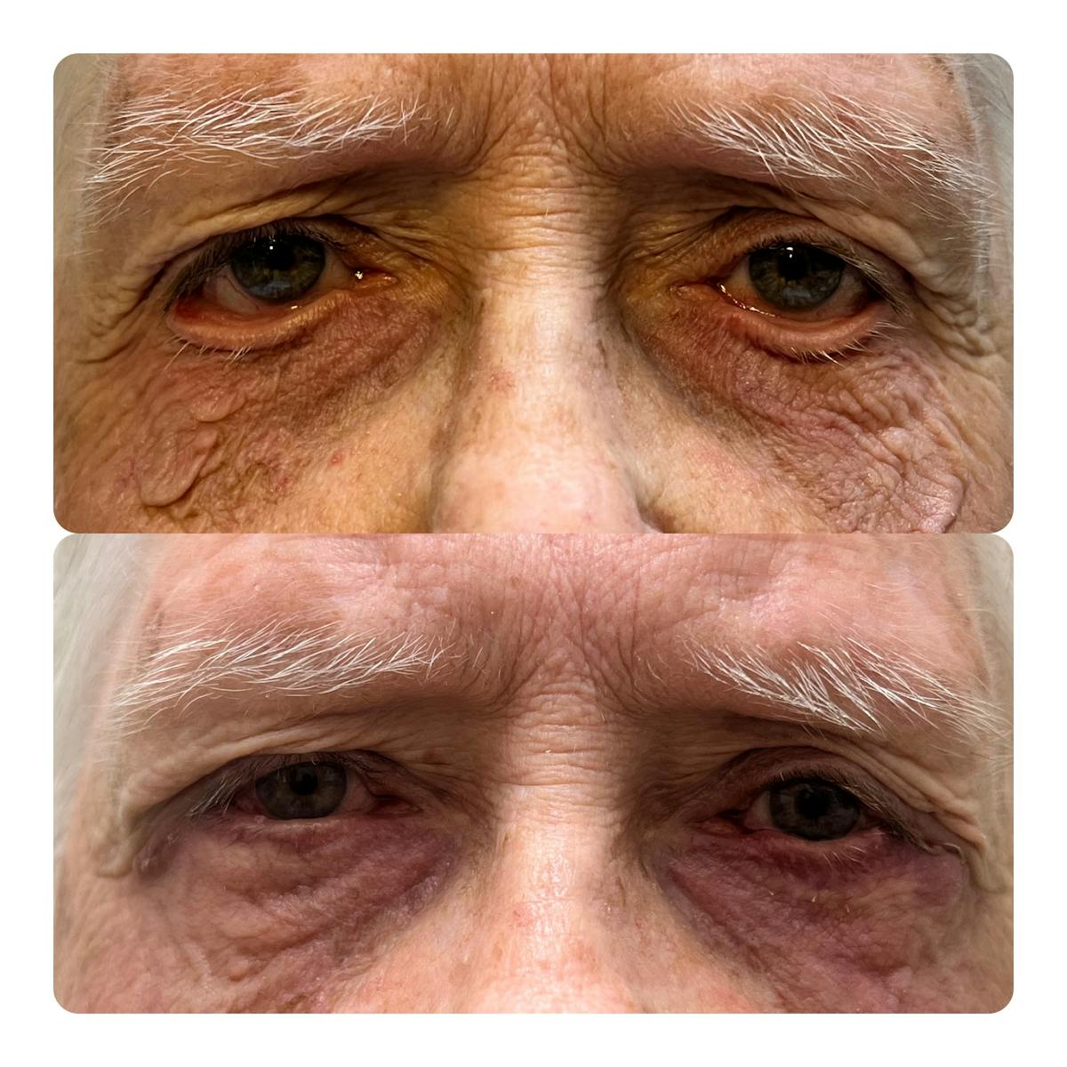 Ptosis Repair Before & After Gallery - Patient 235105 - Image 1