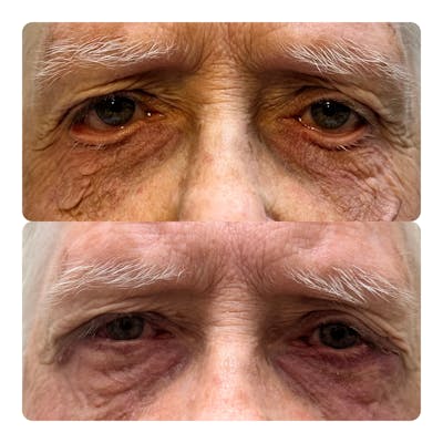 Ptosis Repair Before & After Gallery - Patient 235105 - Image 1
