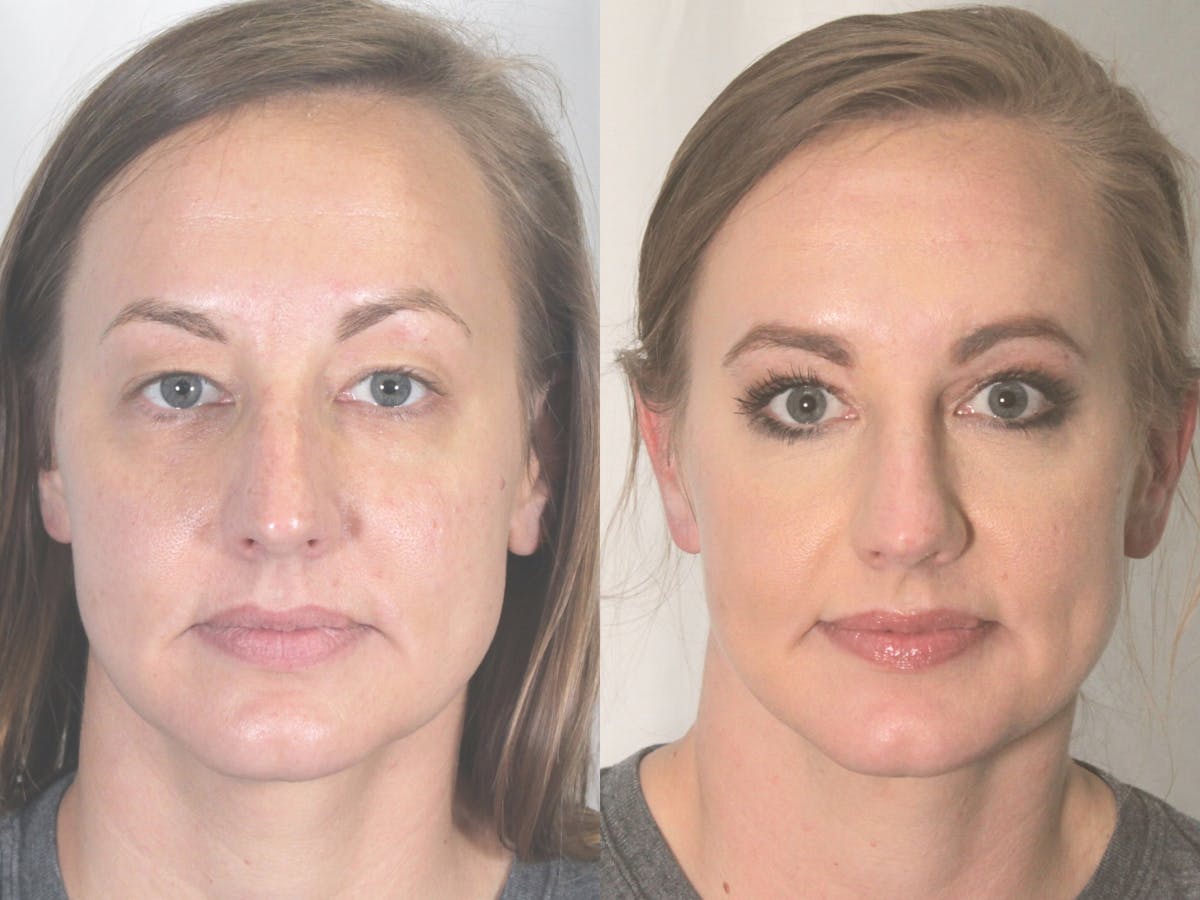 Blepharoplasty Before & After Gallery - Patient 824977 - Image 2