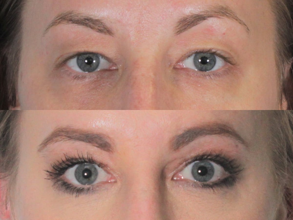 Blepharoplasty Before & After Gallery - Patient 824977 - Image 1