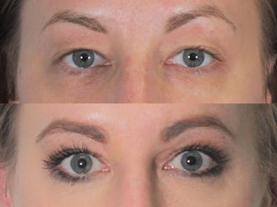 Blepharoplasty Before & After Gallery - Patient 824977 - Image 1