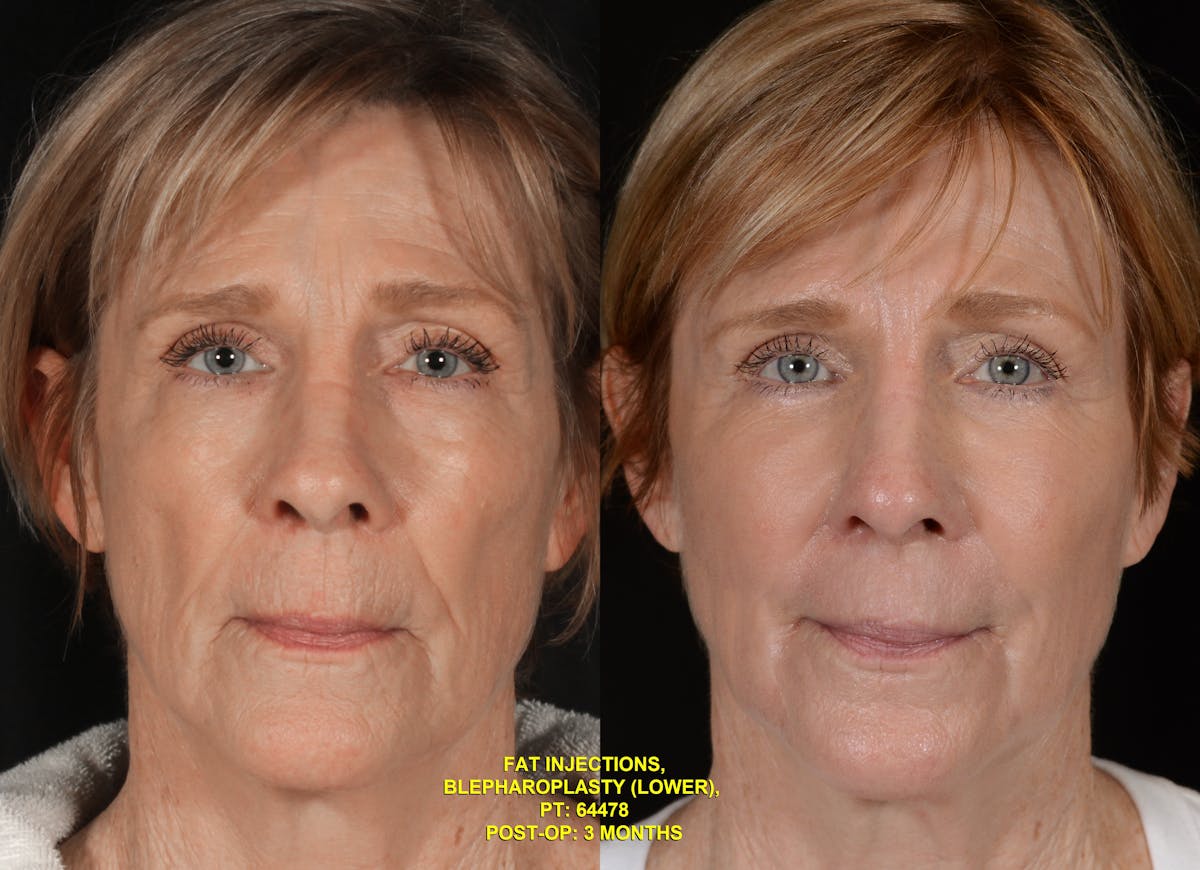 TCA Peel Before & After Gallery - Patient 342985 - Image 1