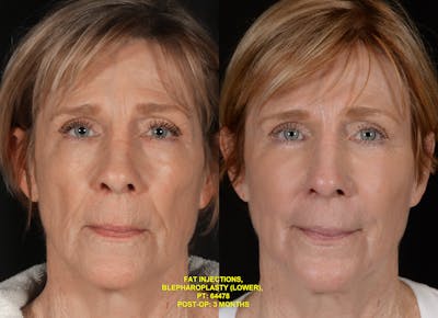 Blepharoplasty Before & After Gallery - Patient 131120 - Image 1