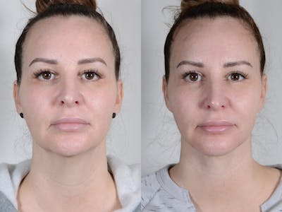 Blepharoplasty Before & After Gallery - Patient 170727 - Image 1