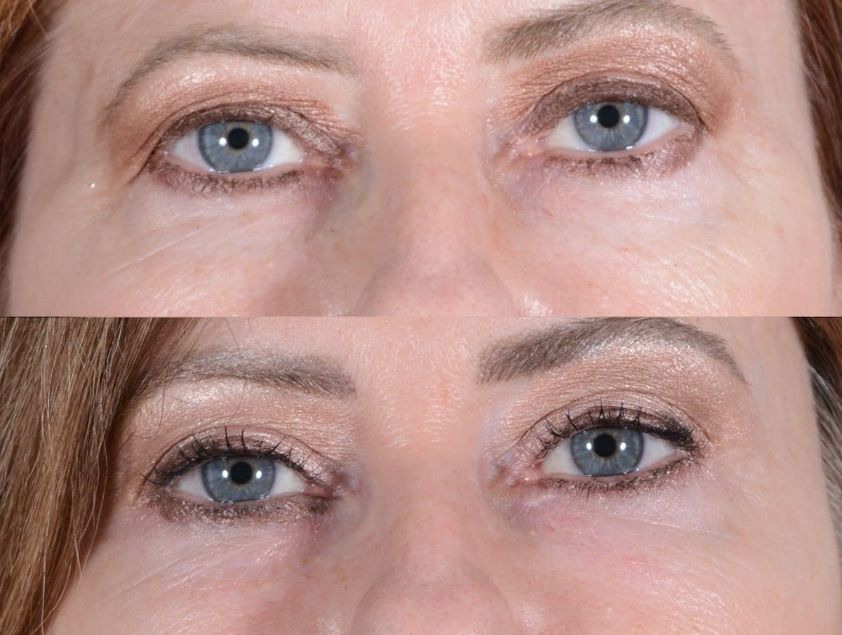 Blepharoplasty Before & After Gallery - Patient 267233 - Image 1