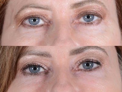 Blepharoplasty Before & After Gallery - Patient 267233 - Image 1