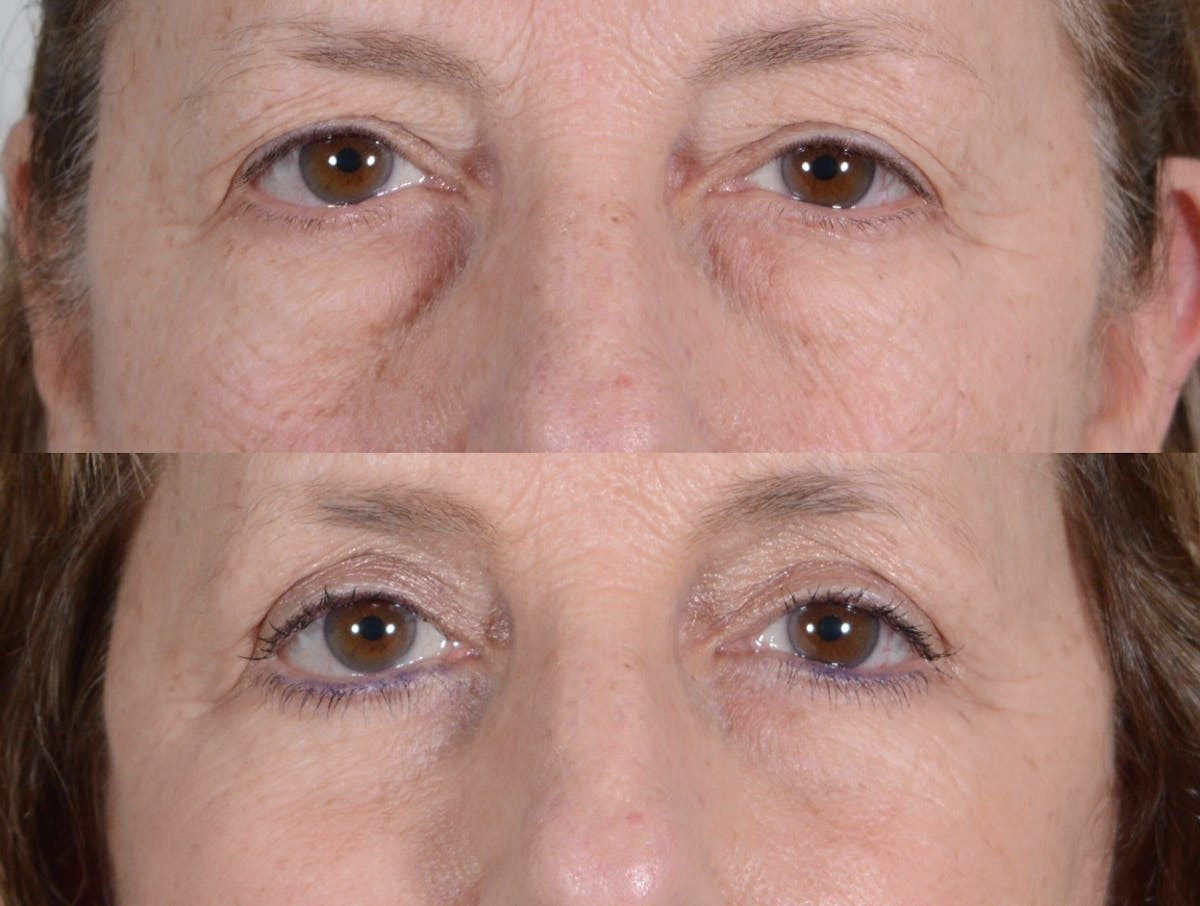Blepharoplasty Before & After Gallery - Patient 196685 - Image 1