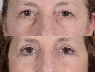 Blepharoplasty Before & After Gallery - Patient 196685 - Image 1