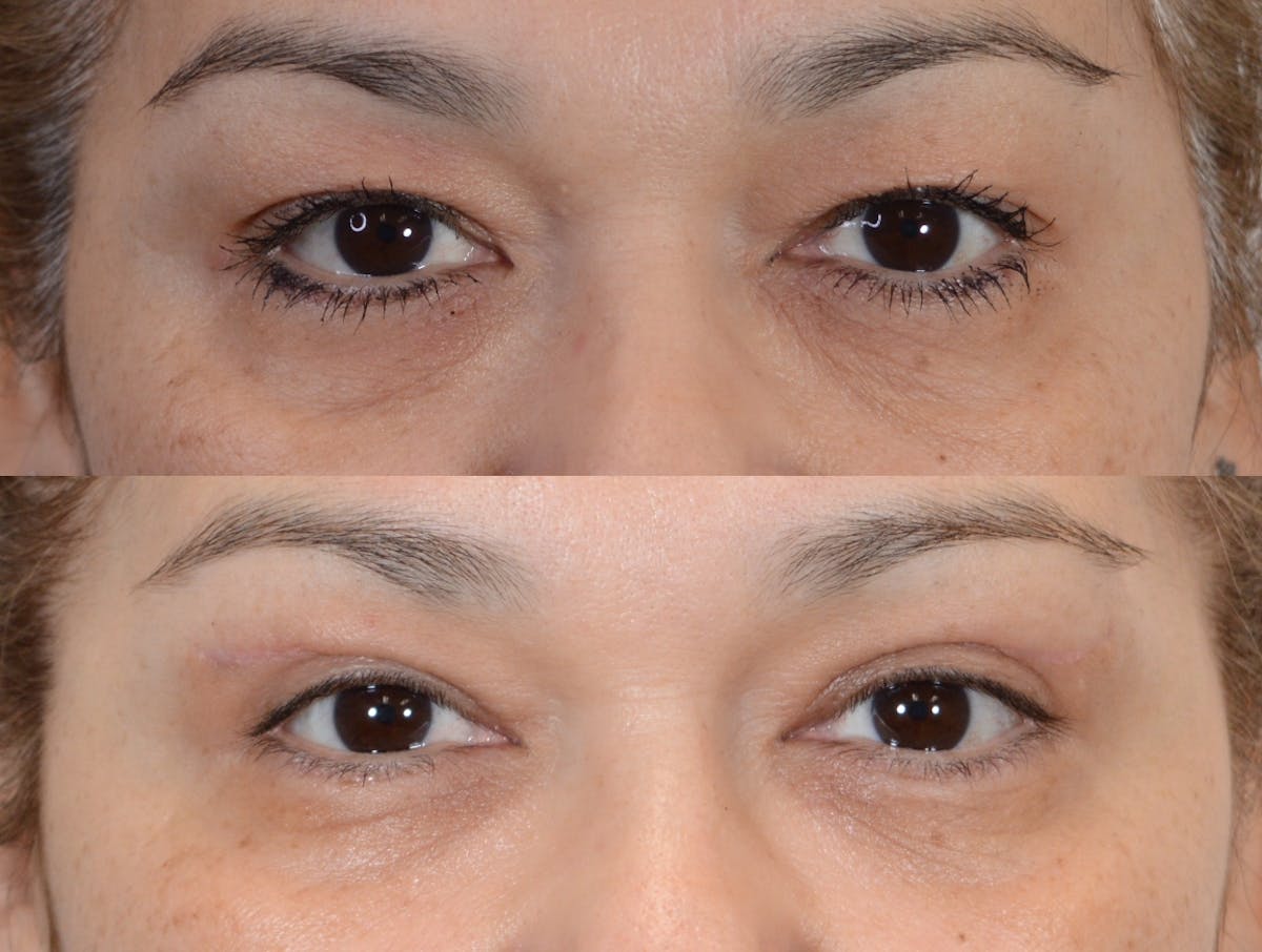 Blepharoplasty Before & After Gallery - Patient 193340 - Image 1