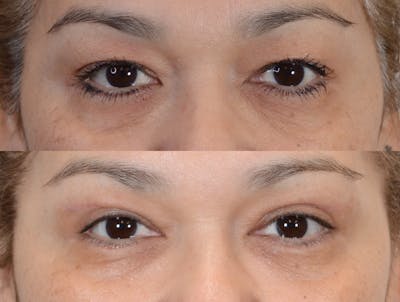 Blepharoplasty Before & After Gallery - Patient 193340 - Image 1