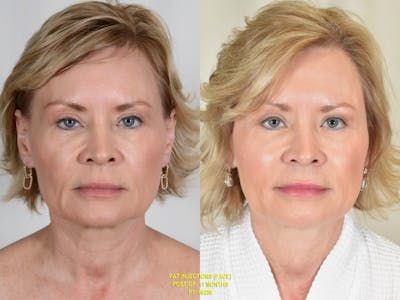 Facial Fat Grafting Before & After Gallery - Patient 139365 - Image 1