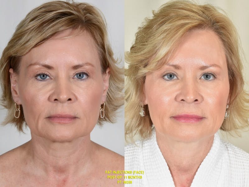 Facial Fat Grafting Before & After Gallery - Patient 139365 - Image 1