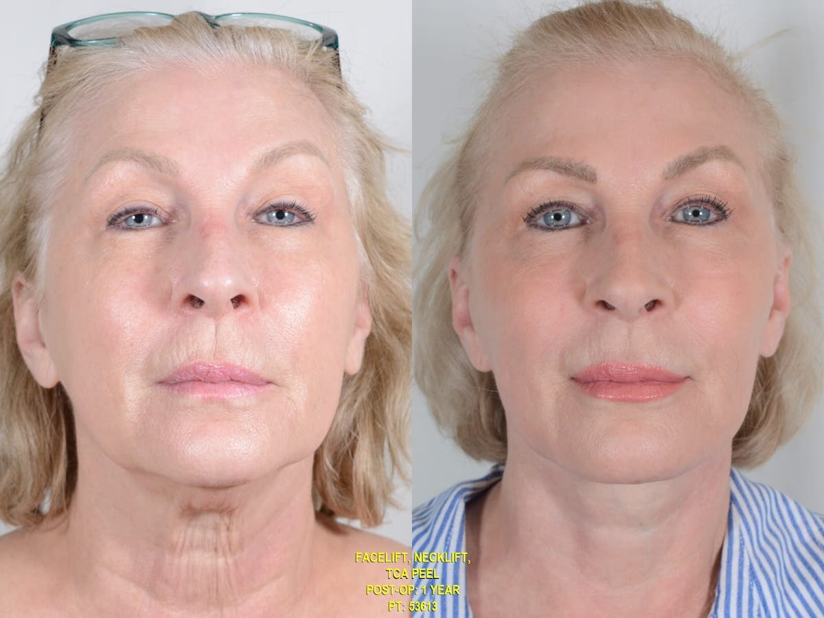 TCA Peel Before & After Gallery - Patient 247270 - Image 1