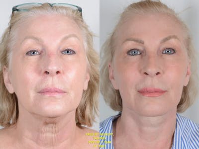 TCA Peel Before & After Gallery - Patient 247270 - Image 1