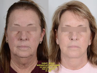 TCA Peel Before & After Gallery - Patient 349453 - Image 1